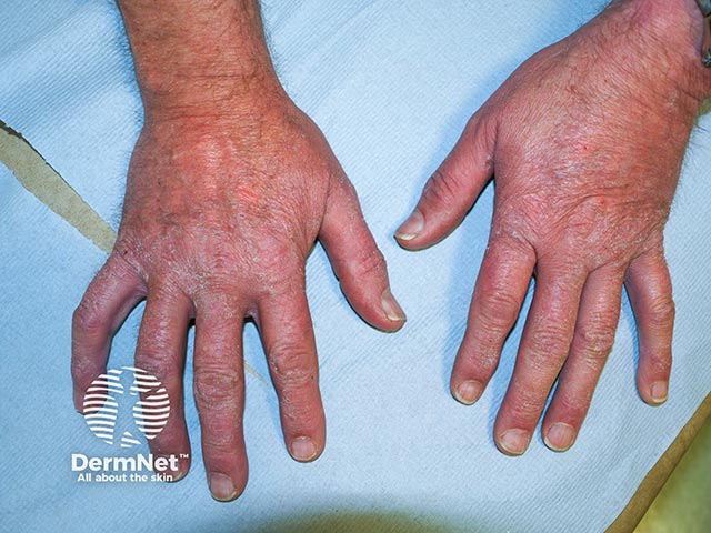Allergic contact dermatitis on the hands