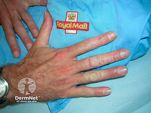 Allergic contact dermatitis from rubber bands used to bundle postal letters