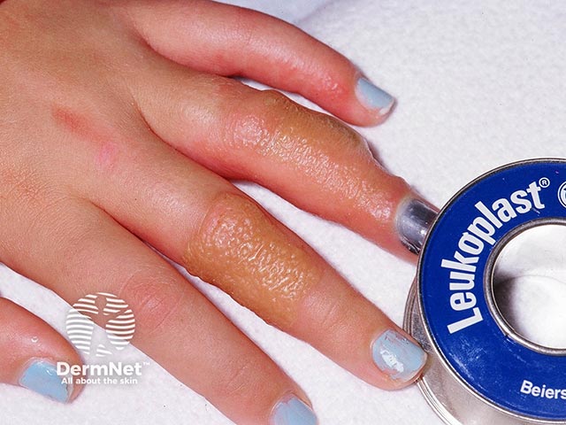 A bullous contact allergic reaction to a tape constituent