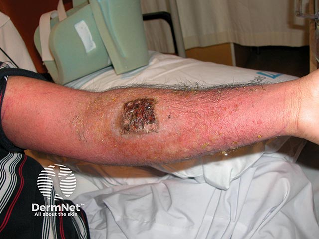 An acute allergic contact dermatitis due to a marking nut used to remove an amateur tattoo