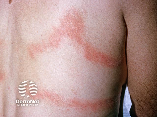 Contact allergy to elastane in a bra