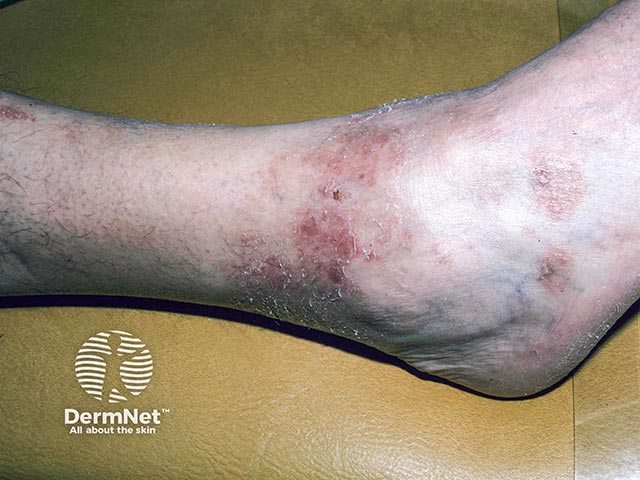 Contact allergy to a neoprene ankle brace