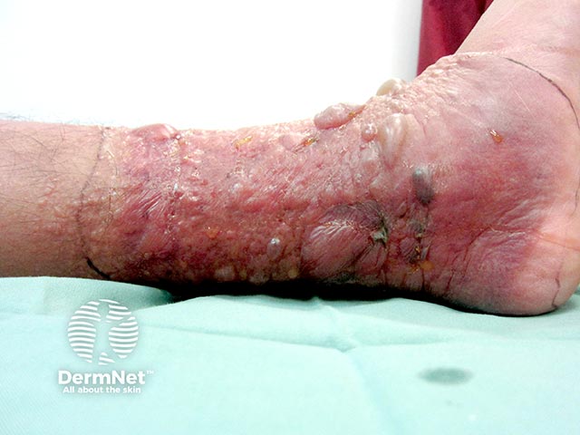 A bullous contact dermatitis due to a bandage constituent