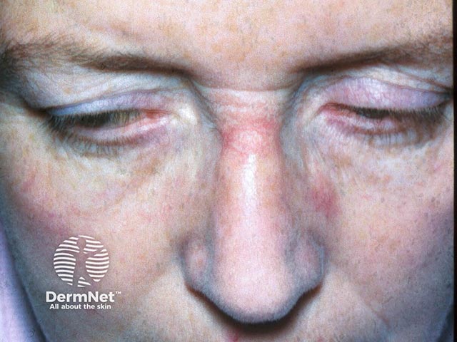 Contact allergy to nickel in a spectacle frame