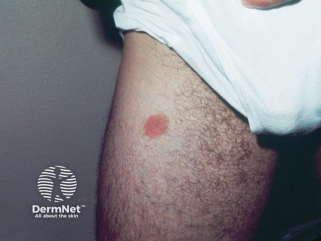 Contact allergy to nickel in a cigarette lighter kept in his trouser pocket