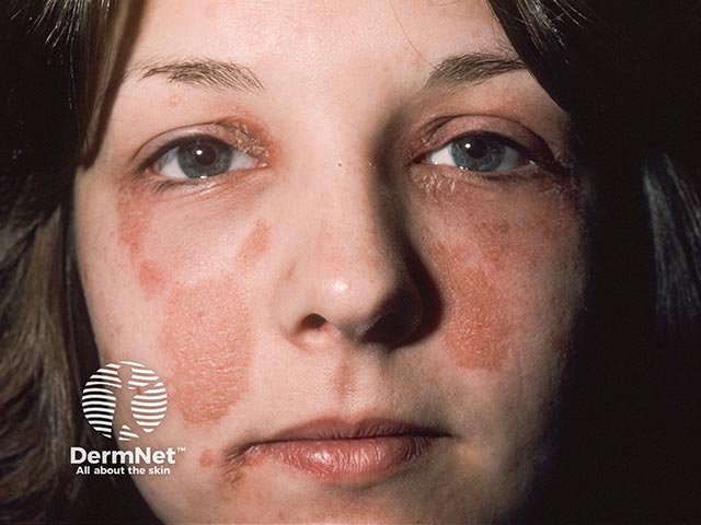 Nickel facial contact dermatitis from use of an eyelash curler