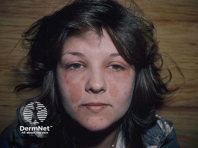 Nickel facial contact dermatitis from use of an eyelash curler