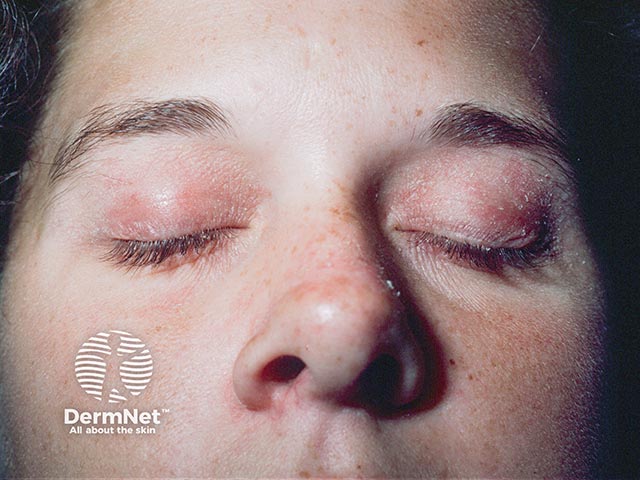 Contact allergy to cigarette smoke producing eyelid eczema