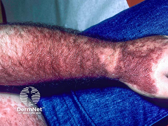 Allergic contact dermatitis on the arms due to rosewood dust