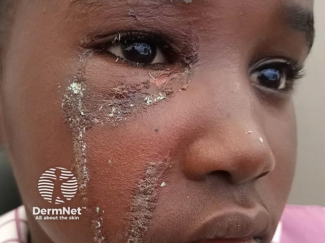 Acute dermatitis from rubbing the face after touching a blister beetle