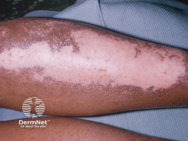 Contact allergy to a cosmetic camouflage constituent used to disguise vitiligo