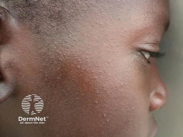 Contact dermatitis on the face due to a herbal face soap