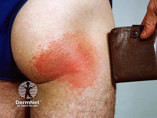 Allergic contact dermatitis due to chromate in a leather wallet