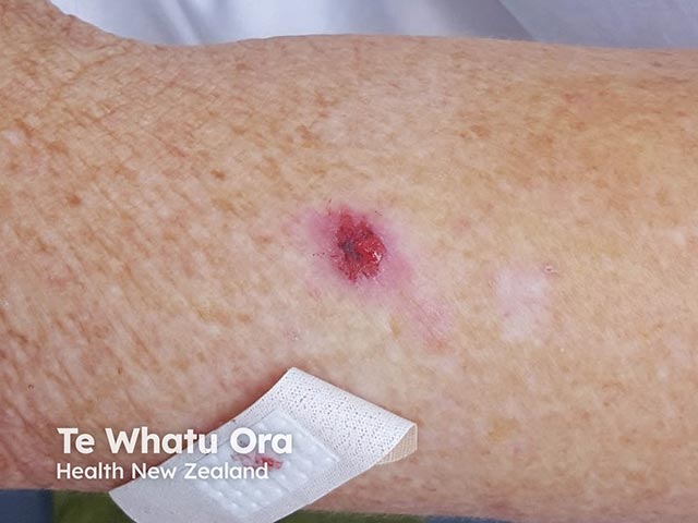 An eroded plaque on the arm - histology showed an amelanotic melanoma