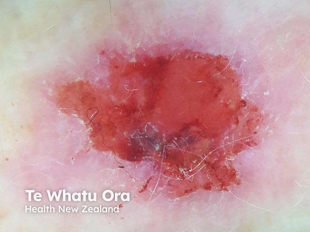 Dermoscopic image of an eroded plaque on the arm - histology showed an amelanotic melanoma