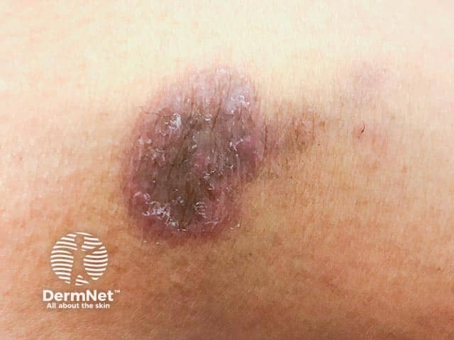Violaceous and pigmented lesion of annular lichen planus on the lower limb 