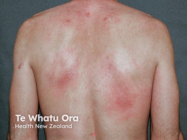 Atopic dermatitis on the trunk