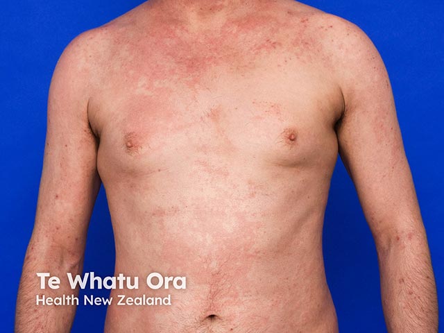 Atopic eczema on the neck, trunk, and limbs