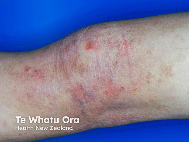 Flexural atopic eczema