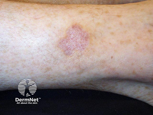 A depressed scarred area of atrophie blanche on the ankle