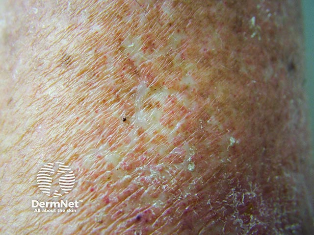 Close-up of reticulate scarring in atrophie blanche