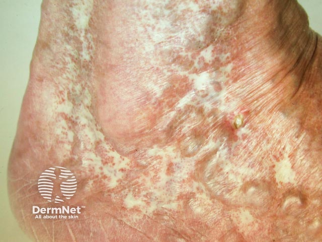 Gross atrophie blanche due to severe venous incompetence