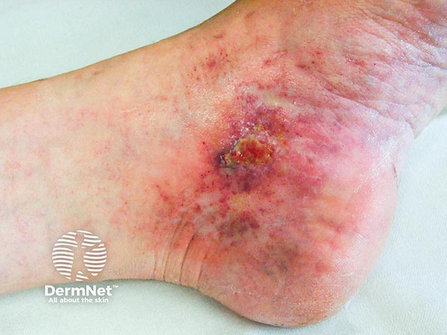 Eczematised and ulcerated atrophie blanche on the ankle