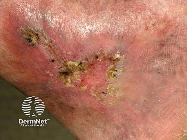 Eczematised and ulcerated atrophie blanche 