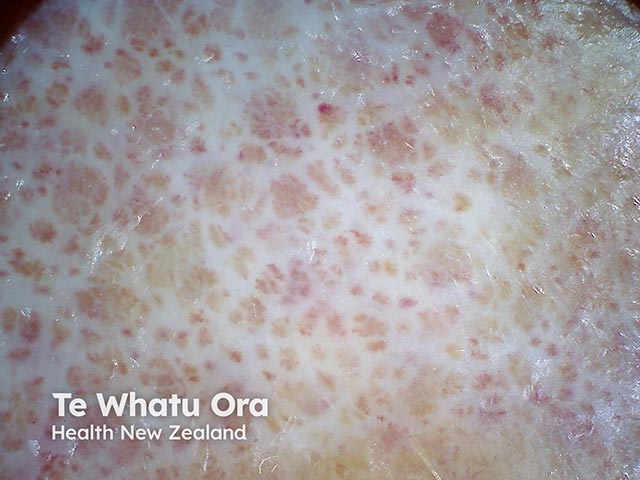 Reticulated white scars with enlarged central vessels due to atrophie blanche