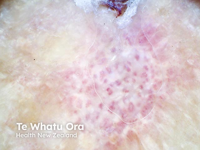 Reticulated white scars with enlarged central vessels due to atrophie blanche