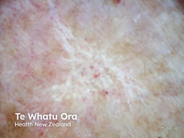 Dermoscopy of atrophie blanche