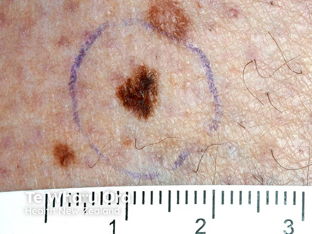 A variably-pigmented, irregularly-marginated naevus - histology showed a dysplastic naevus