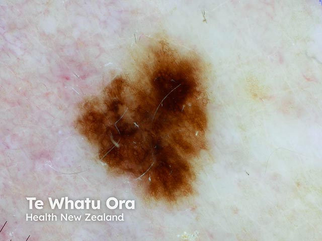 A variably-pigmented, irregularly-marginated naevus - histology showed a dysplastic naevus