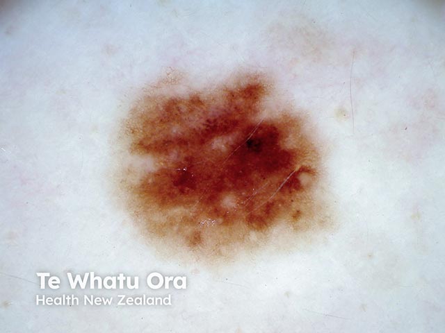 Dermoscopy of an atypical naevus