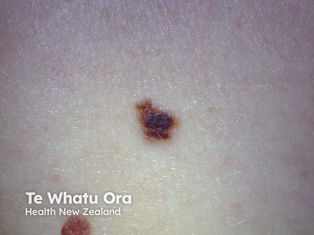 Asymmetric, variably-pigmented, and irregularly-marginated atypical naevus