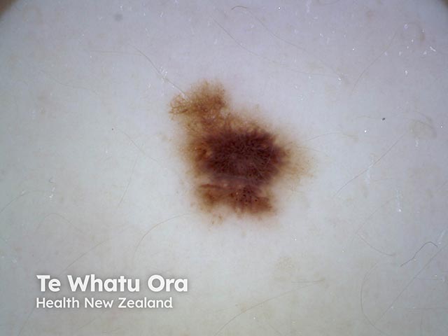 Dermoscopy of an atypical naevus