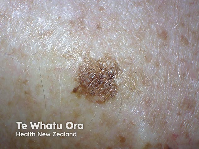 An atypical lentiginous naevus