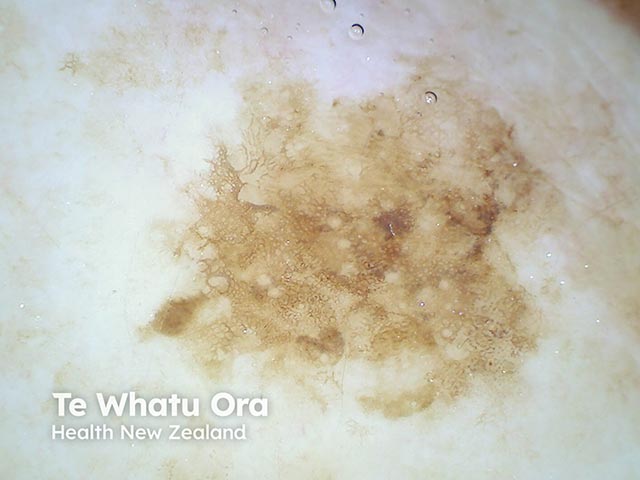 An atypical lentiginous naevus