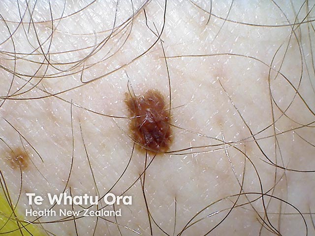 An atypical naevus - note the notching and irregular pigmentation