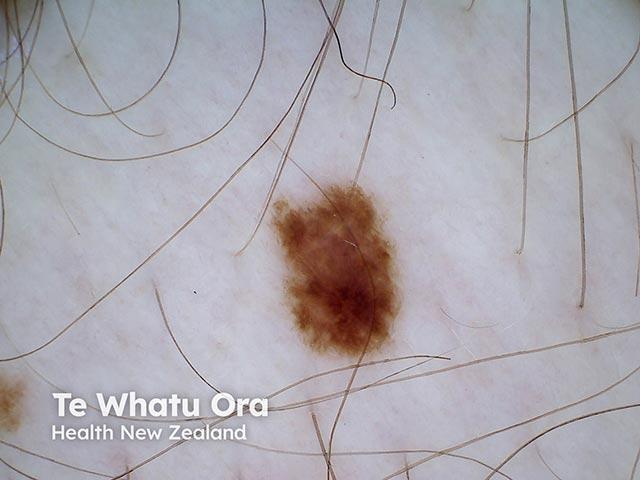 An atypical naevus - note the notching and irregular pigmentation