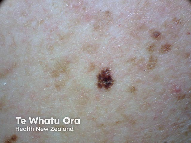 A darkly-pigmented, irregular atypical naevus