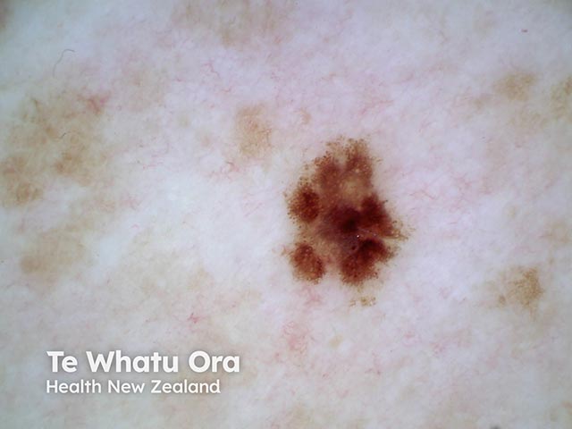 Dermoscopy of an atypical naevus