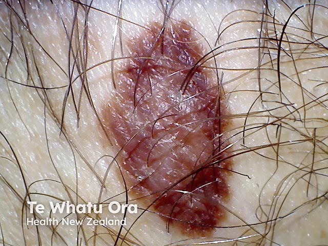 Irregularly-pigmented, moderately-large atypical naevus