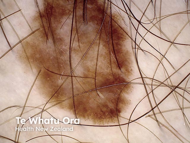 Dermoscopy of an atypical naevus with peripheral dots