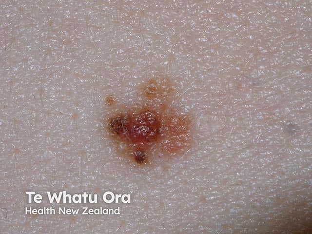 Atypical compound naevus