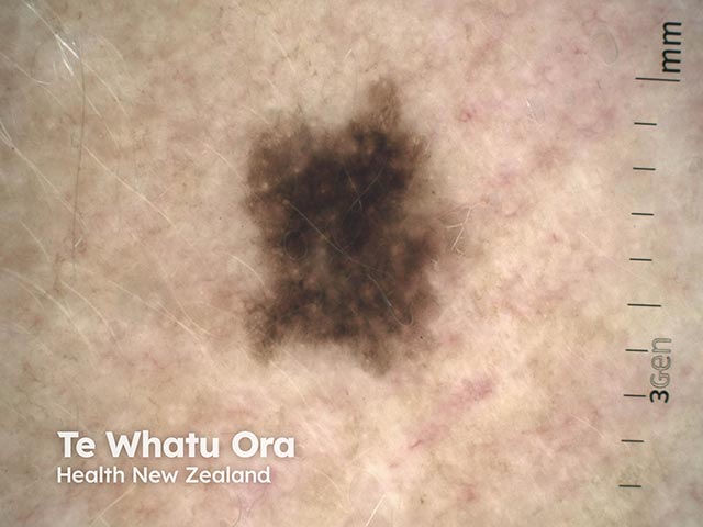 Dermoscopy of a dysplastic naevus