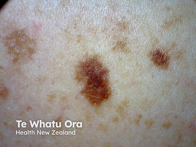 An atypical naevus with irregular pigmentation and margins