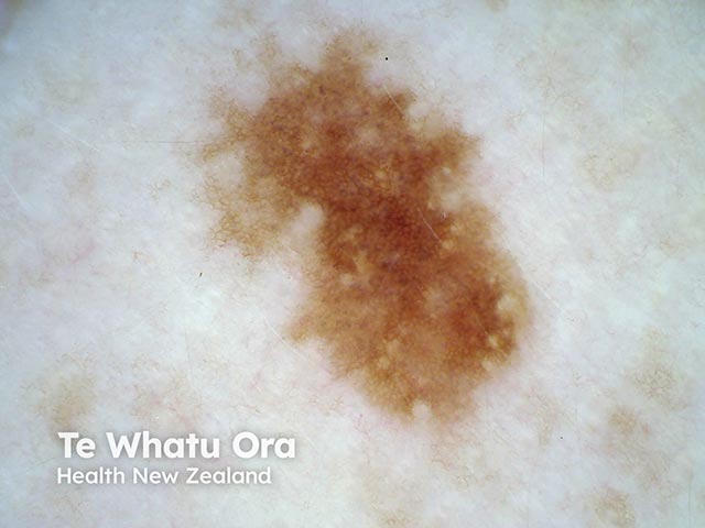 Dermoscopy of an atypical naevus