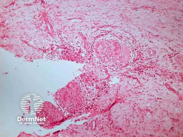Granulomatous inflammation and giant cells in Mycobacteriium marinum infection biopsy