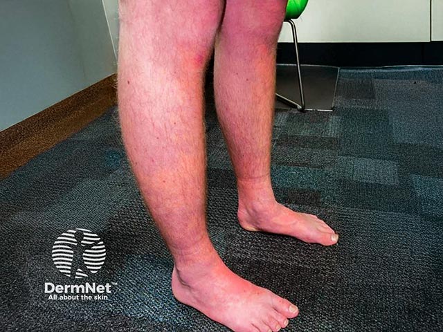 Bier spots (white macules due to diminished blood flow) on the legs